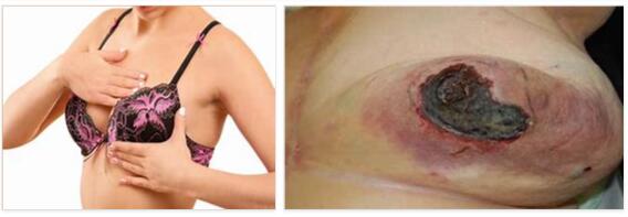 Nipple Inflammation Explained